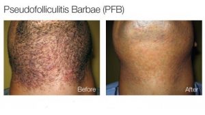 Difference Between Sycosis Barbae And Pseudofolliculitis Barbae My