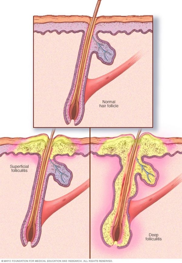 Difference Between Sycosis Barbae And Pseudofolliculitis Barbae – My ...