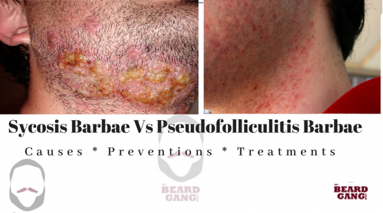 Difference Between Sycosis Barbae And Pseudofolliculitis Barbae | My ...