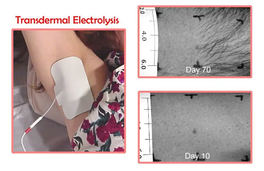 Electrolysis Hair Removal at Home My Beard Gang