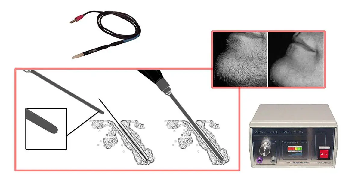 Review of Best Home Electrolysis Machine My Beard Gang