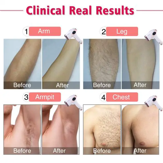 Best Laser Hair Removal Machines for Sensitive Skin My Beard Gang