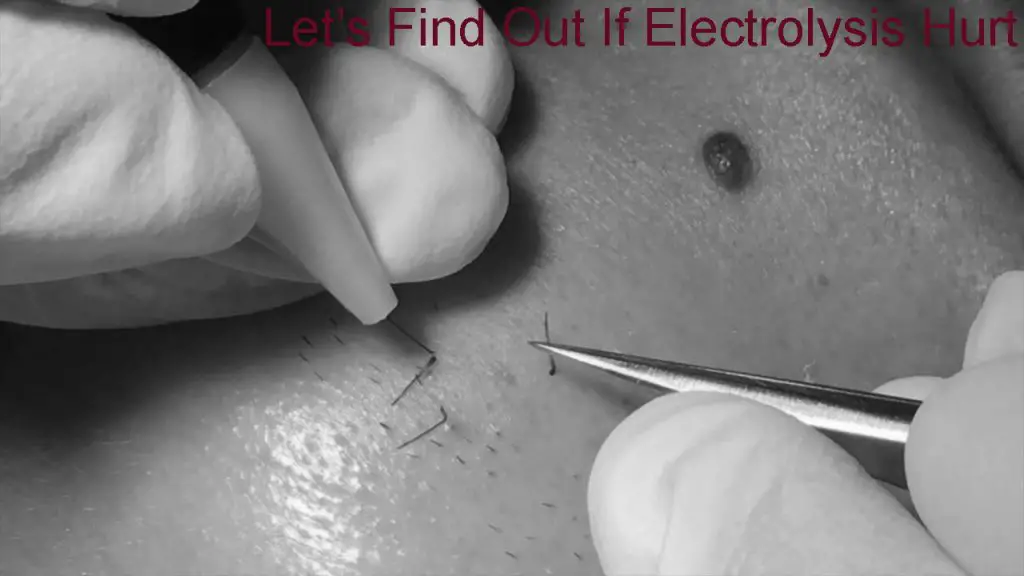 Does Electrolysis Hurt? Let’s Find Out Does Electrolysis Hurt? Let’s Find Out